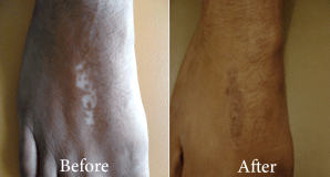 Vitiligo Surgery